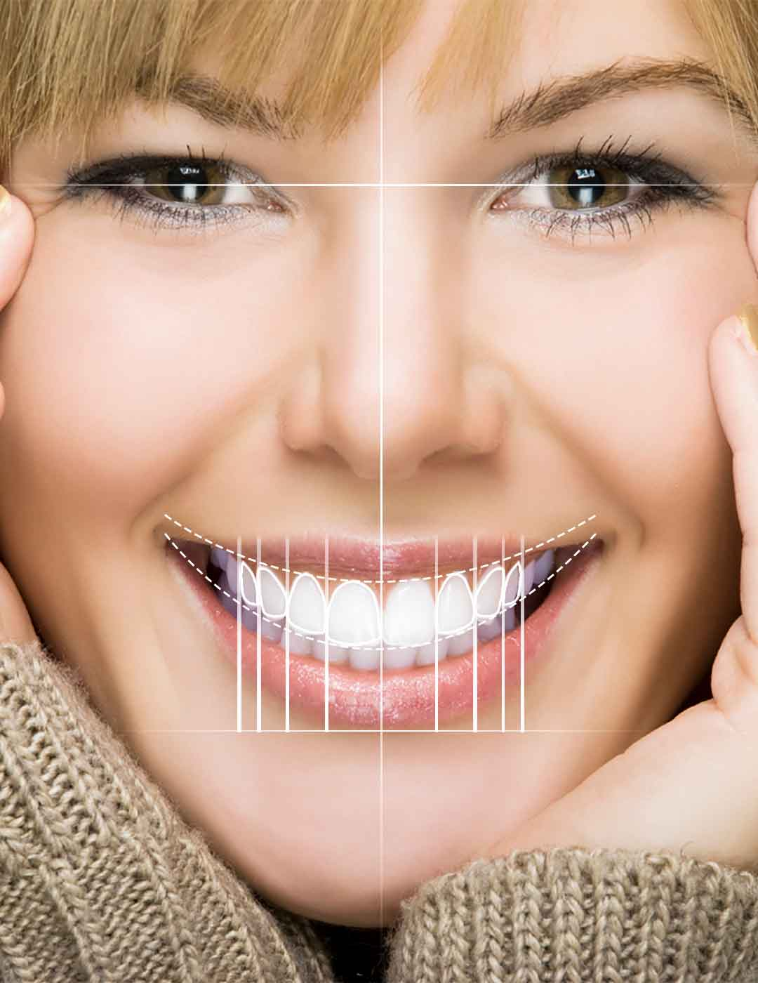 Smile Designing (Veneers)