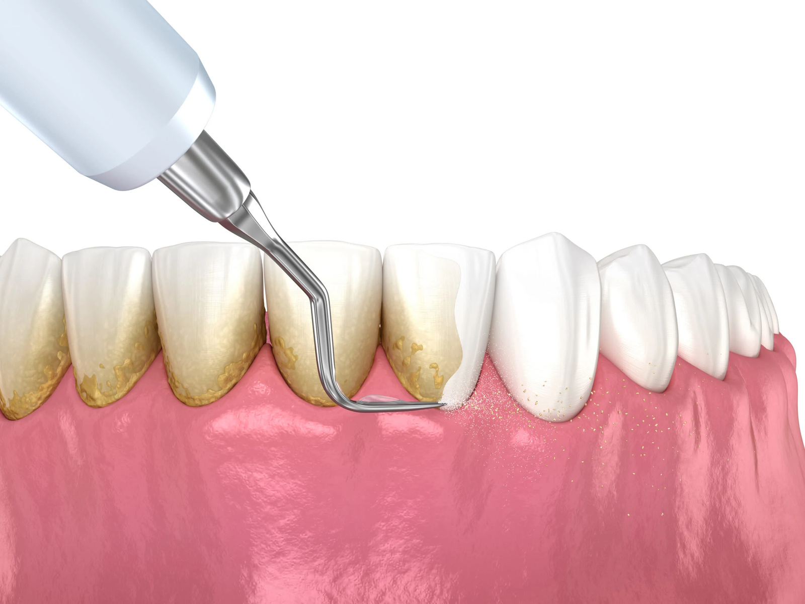 Teeth Cleaning (Scaling)